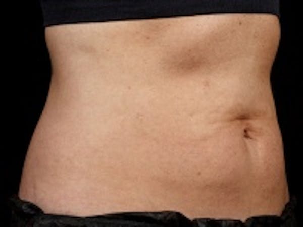 Non-Invasive Fat Removal Before & After Gallery - Patient 5930243 - Image 2