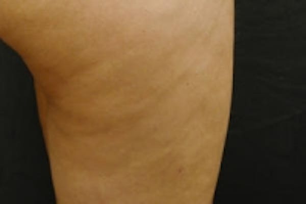 Cellulite Treatments Before & After Gallery - Patient 5930242 - Image 2