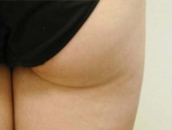 SmartLipo Before & After Gallery - Patient 5930244 - Image 4