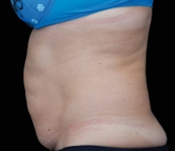 Non-Invasive Fat Removal Before & After Gallery - Patient 5930249 - Image 1