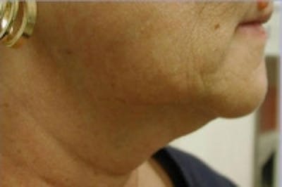 SmartLipo Before & After Gallery - Patient 5930250 - Image 1