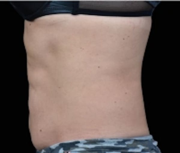 Non-Invasive Fat Removal Before & After Gallery - Patient 5930249 - Image 2