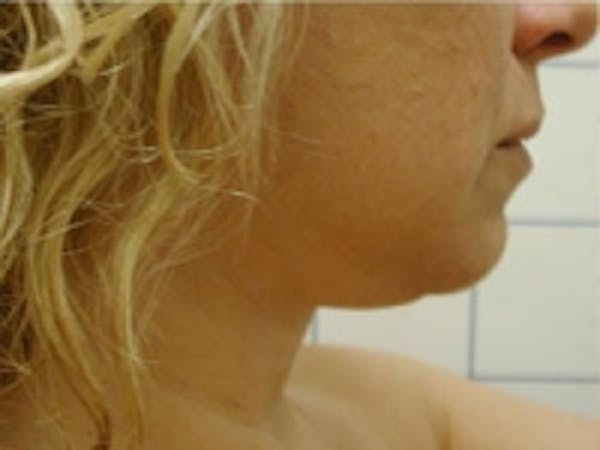 SmartLipo Before & After Gallery - Patient 5930257 - Image 1