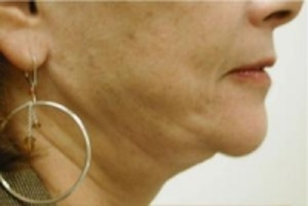 Before and after lipo in NYC at JUVA Skin & Laser Center