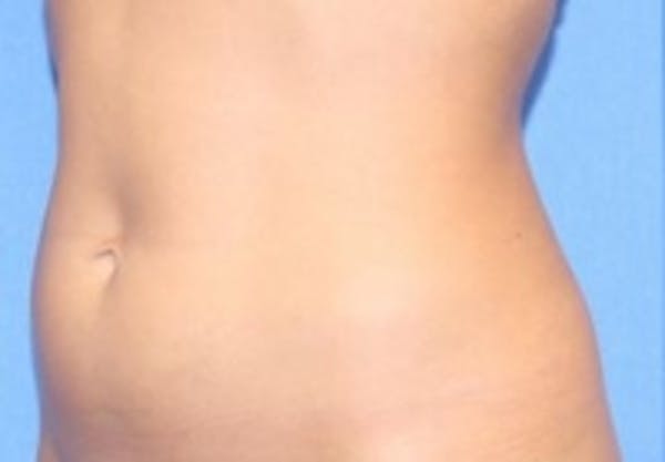 Skin Tightening Before & After Gallery - Patient 5930254 - Image 1