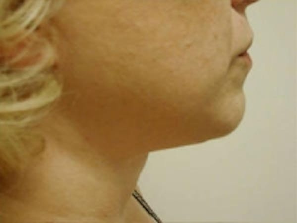 SmartLipo Before & After Gallery - Patient 5930257 - Image 2