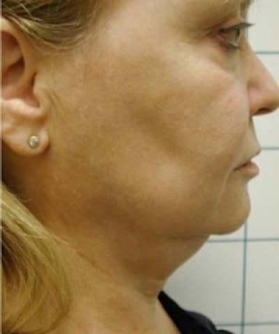 Liposuction Before & After Gallery - Patient 5930255 - Image 1