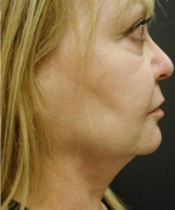 Liposuction Before & After Gallery - Patient 5930255 - Image 2