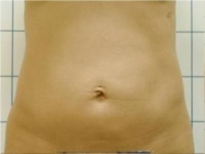 Liposuction Before & After Gallery - Patient 5930260 - Image 1