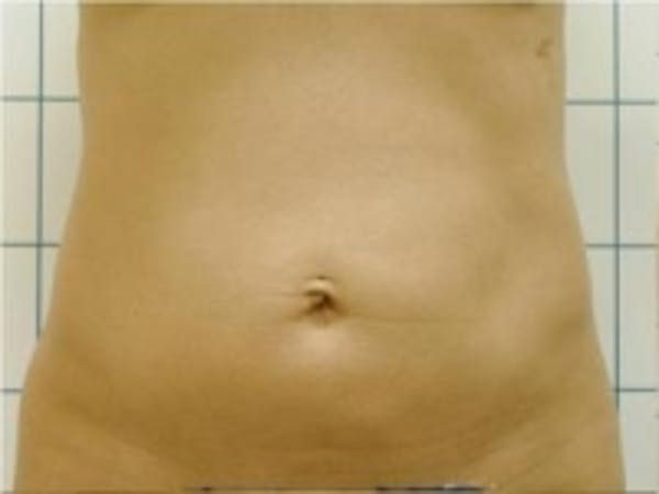 Liposuction Before & After Gallery - Patient 5930260 - Image 1