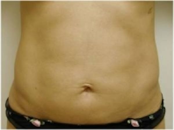 Liposuction Before & After Gallery - Patient 5930260 - Image 2