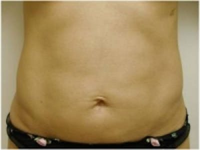Liposuction Before & After Gallery - Patient 5930260 - Image 2