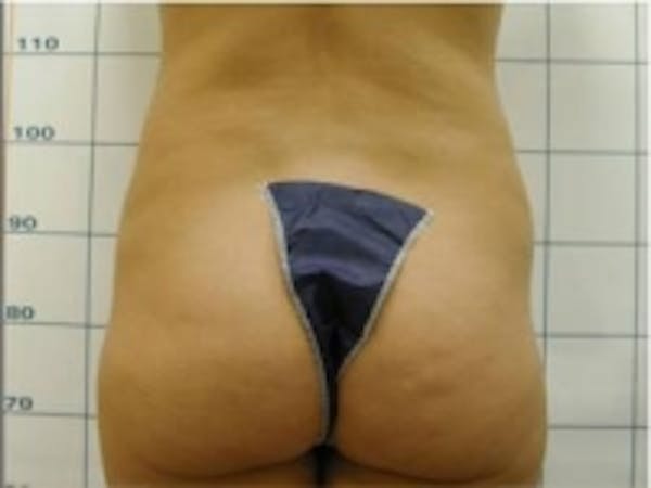 Liposuction Before & After Gallery - Patient 5930260 - Image 3