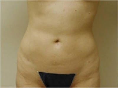 SmartLipo Before & After Gallery - Patient 5930261 - Image 2