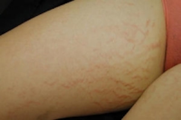 Stretch Mark Removal