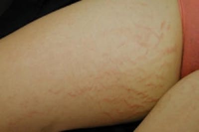 Stretch Marks Before & After Gallery - Patient 5930266 - Image 1