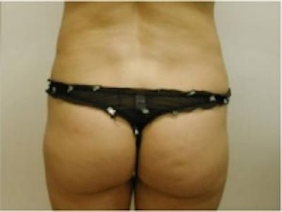 Liposuction Before & After Gallery - Patient 5930260 - Image 4