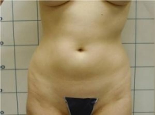 Liposuction Before & After Gallery - Patient 5930264 - Image 1
