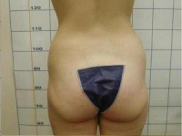 Liposuction Gallery - Patient 5930264 - Image 3