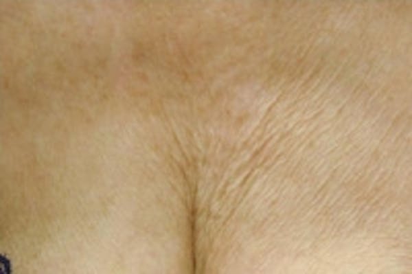 Laser Chest Rejuvenation Before & After Gallery - Patient 5930265 - Image 1