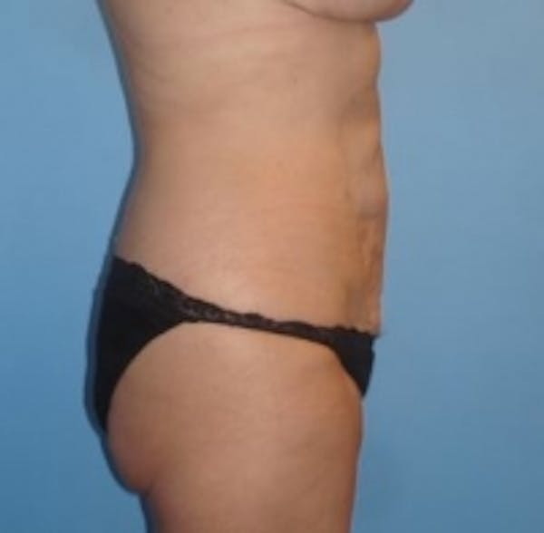 Skin Tightening Before & After Gallery - Patient 5930263 - Image 2