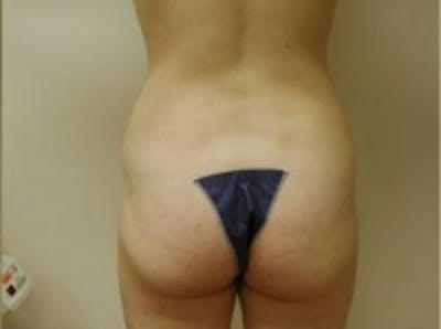 Liposuction Before & After Gallery - Patient 5930264 - Image 4