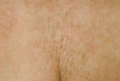 Laser Chest Rejuvenation Before & After Gallery - Patient 5930265 - Image 2