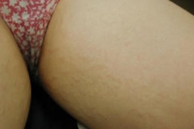 Stretch Marks Before & After Gallery - Patient 5930266 - Image 6