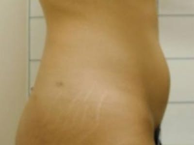 Liposuction Before & After Gallery - Patient 5930271 - Image 1
