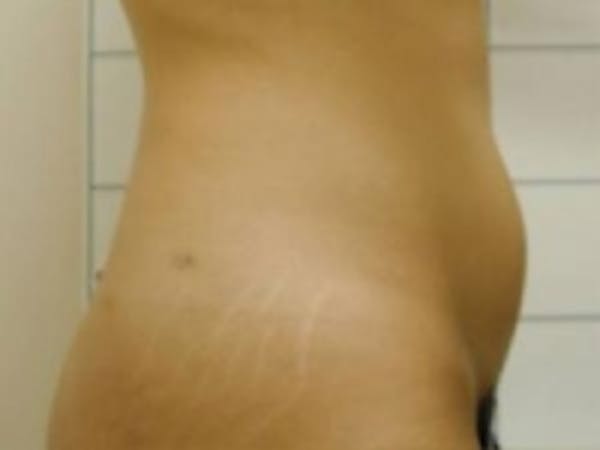 Liposuction Gallery - Patient 5930271 - Image 1
