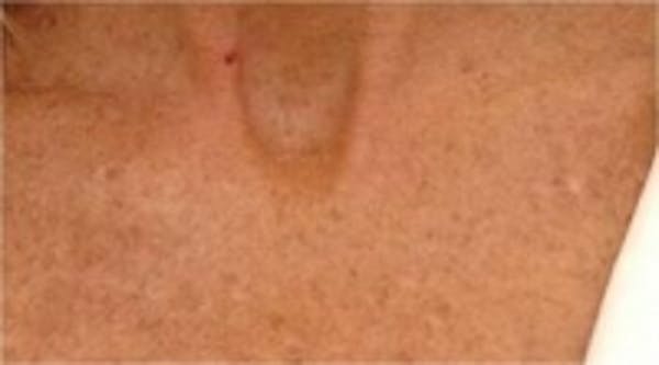 Laser Chest Rejuvenation Before & After Gallery - Patient 5930268 - Image 1