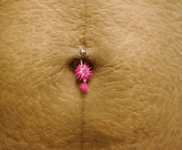 Stretch Marks Before & After Gallery - Patient 5930270 - Image 1