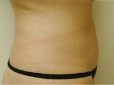 Liposuction Before & After Gallery - Patient 5930271 - Image 2