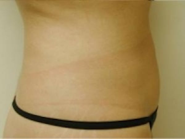 Liposuction Before & After Gallery - Patient 5930271 - Image 2