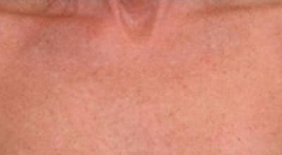 Laser Chest Rejuvenation Before & After Gallery - Patient 5930268 - Image 2