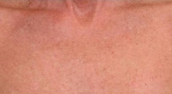 Laser Chest Rejuvenation Before & After Gallery - Patient 5930268 - Image 2