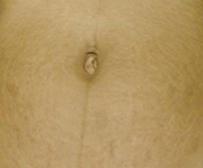 Stretch Marks Before & After Gallery - Patient 5930270 - Image 2
