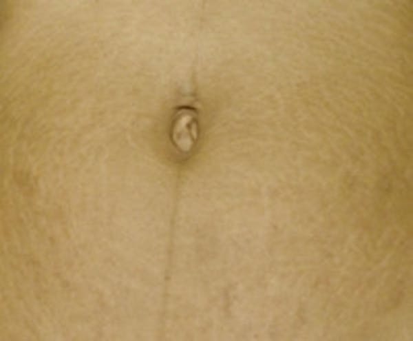 Stretch Marks Before & After Gallery - Patient 5930270 - Image 2
