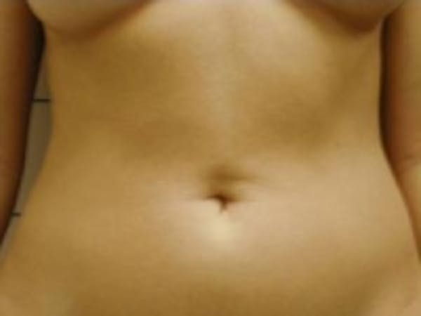 Liposuction Before & After Gallery - Patient 5930271 - Image 3