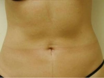 Liposuction Before & After Gallery - Patient 5930271 - Image 4