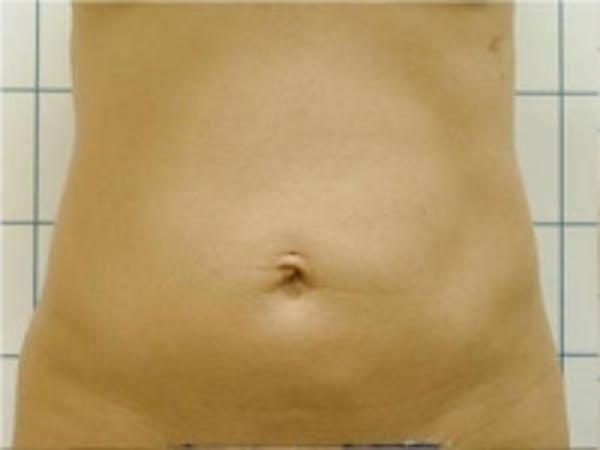 SmartLipo Before & After Gallery - Patient 5930273 - Image 1