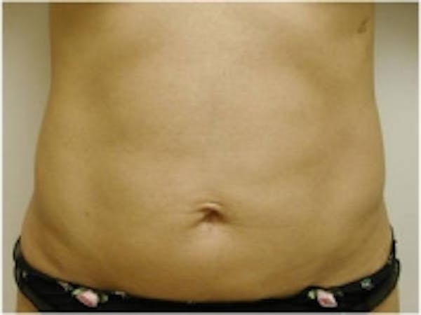 SmartLipo Before & After Gallery - Patient 5930273 - Image 2