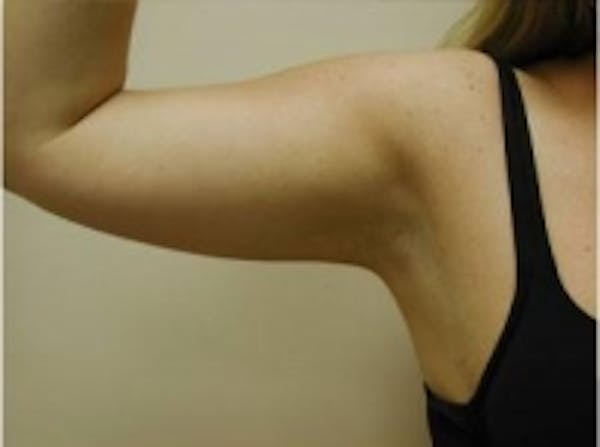 Liposuction Before & After Gallery - Patient 5930272 - Image 2
