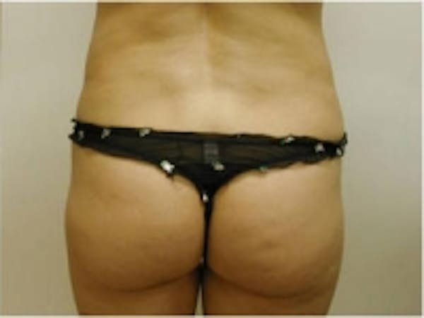 SmartLipo Before & After Gallery - Patient 5930273 - Image 4