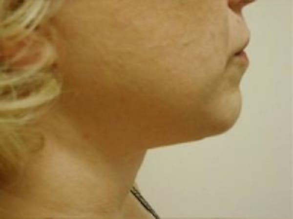 Liposuction Before & After Gallery - Patient 5930283 - Image 2