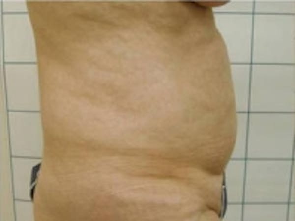 SmartLipo Before & After Gallery - Patient 5930292 - Image 1