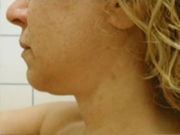 Liposuction Before & After Gallery - Patient 5930283 - Image 3