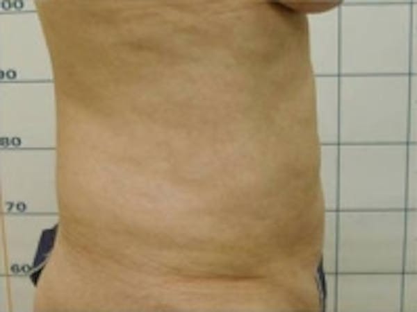 SmartLipo Before & After Gallery - Patient 5930292 - Image 2