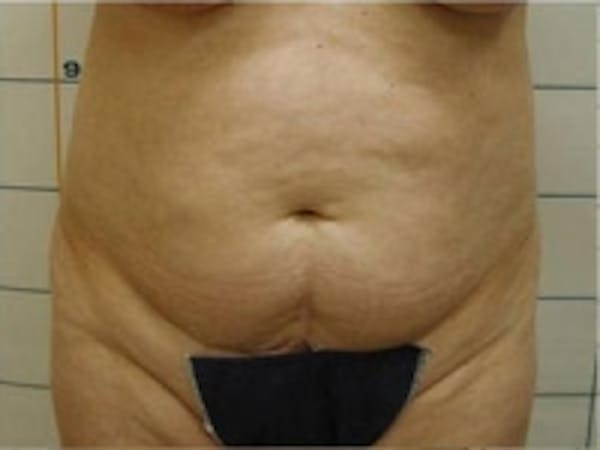 SmartLipo Before & After Gallery - Patient 5930292 - Image 3
