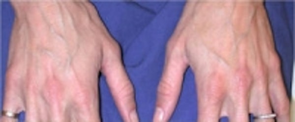Hand Rejuvenation before and after photos